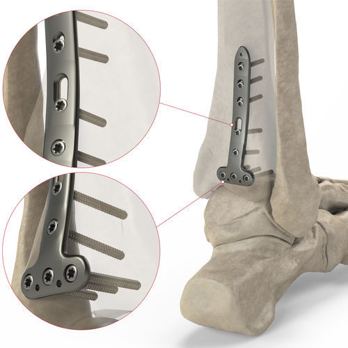 胫骨加压接骨板 - Ases Orthopedics - 远侧 / 锁定