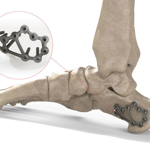 跟骨加压接骨板 - Ases Orthopedics - 锁定
