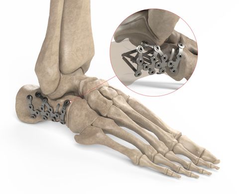 跟骨加压接骨板 - Ases Orthopedics