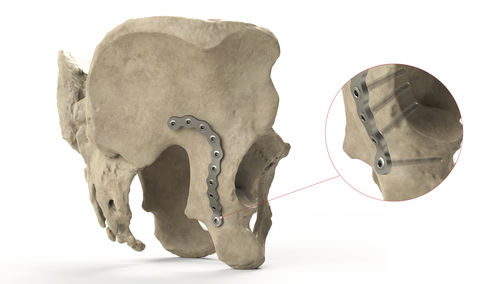 骨盆加压接骨板 - Ases Orthopedics - 后近地点