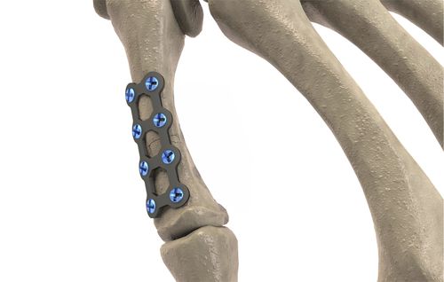 掌骨加压接骨板 - 1T112-10061506 - Ases Orthopedics - 锁定