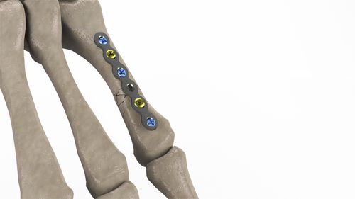 掌骨加压接骨板 - 1T112-10092006 - Ases Orthopedics - 锁定