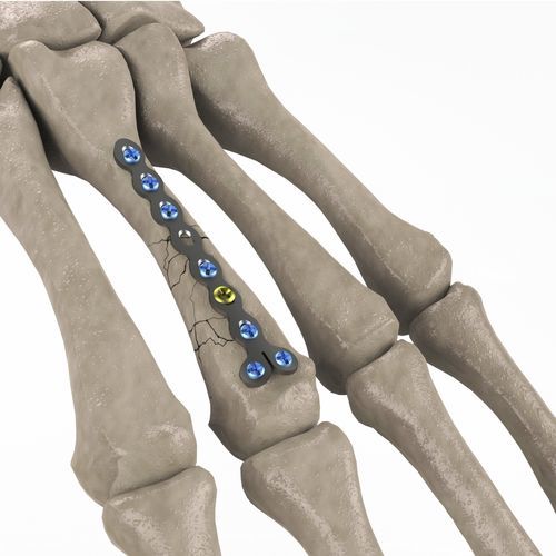 掌骨加压接骨板 - 1T112-100102023 - Ases Orthopedics - 锁定