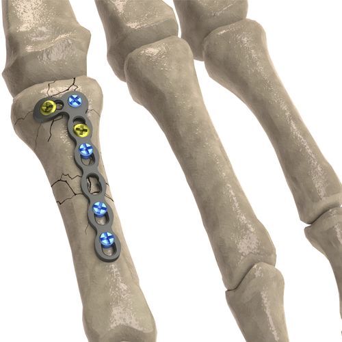 手指骨加压接骨板 - 1T112-100242705L - Ases Orthopedics - 锁定