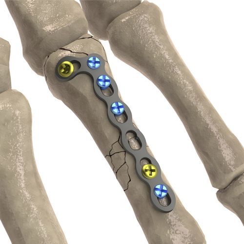 手指骨加压接骨板 - LCP Oblique L - Ases Orthopedics - 锁定