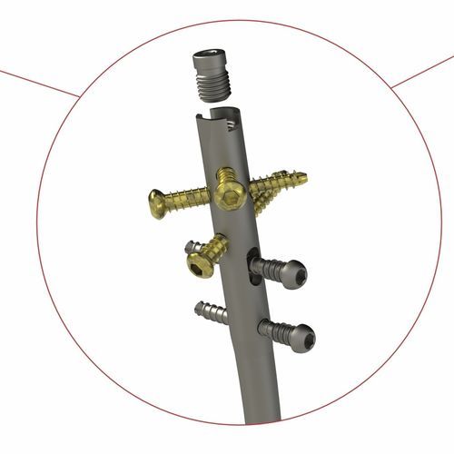 胫骨髓内钉 - 4T1-4011000 - Ases Orthopedics