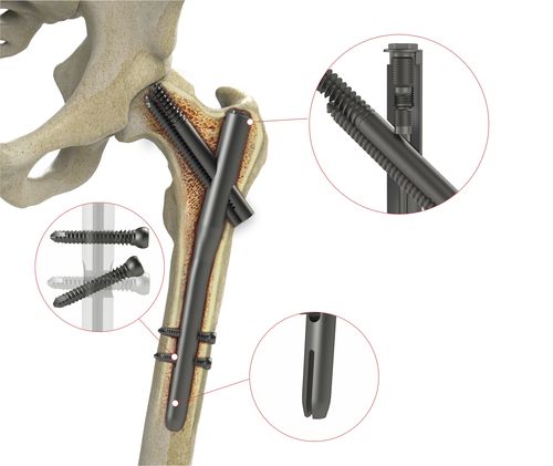 股骨髓内钉 - 4T1-40310170 - Ases Orthopedics - 近端固定