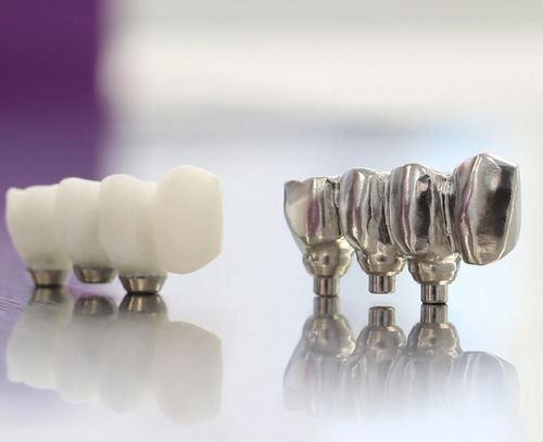 钛牙桥 - Copywax - Panthera Dental - 钴铬合金 / 丙烯塑料 / 氧化锆