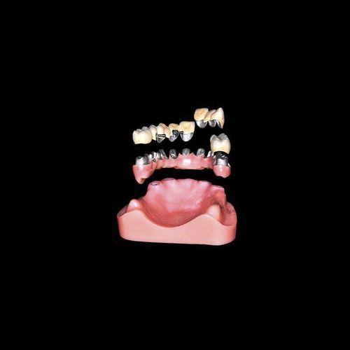 圆锥形牙齿植入物 - Shenzhen Alcadent Co.Ltd Alcadent Dental Laboratory - 金属 / 直线型 / 牙科实验室用
