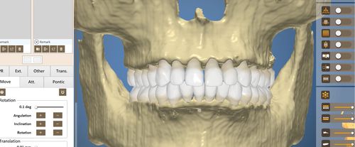 牙科软件 - OrthoAnalysis - Inteware Co., Ltd - 分析 / 加工 / 治疗计划制定