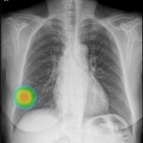 放射学软件 - INSIGHT CXR - Lunit - 医用 / 筛查 / 肺部