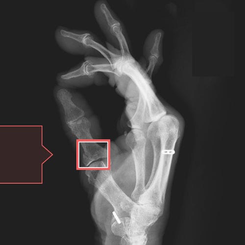 裂缝检测软件 - RBfracture™ - Radiobotics - 医用 / 急救 / 用于放射学