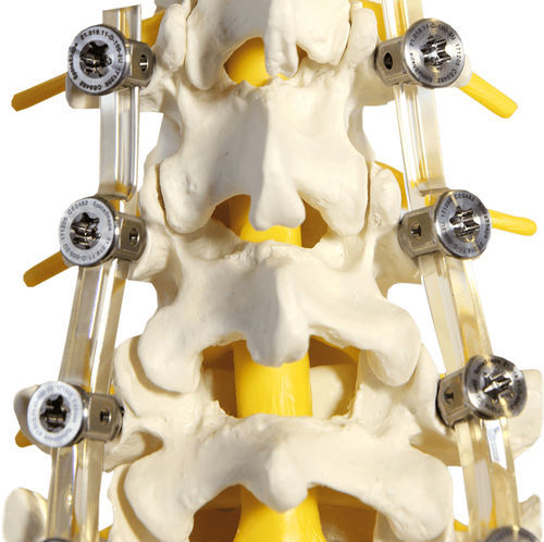 腰椎脊柱内固定系统 - SpineShape System IV - SpineSave - 后入路