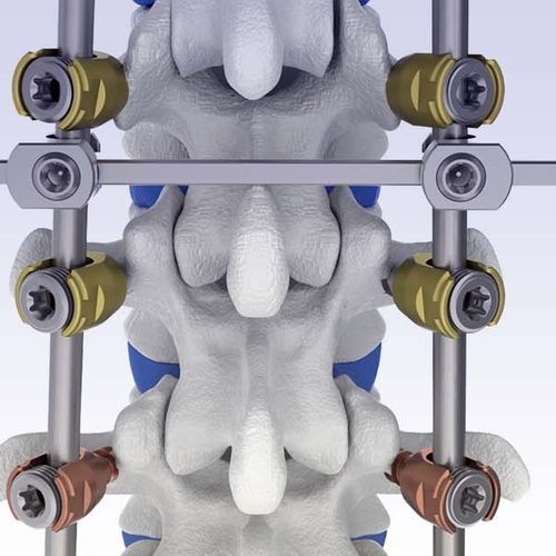 胸腰椎脊柱内固定系统 - VENUS® - HumanTech Dental - 后入路