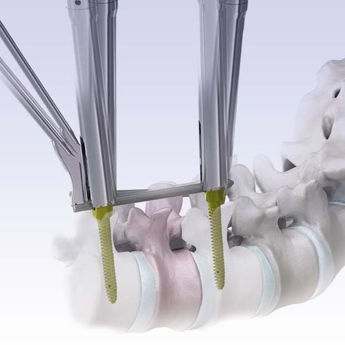 椎间盘螺钉定位系统 / 微创 - VENUS®mini 2.0 - HumanTech Dental