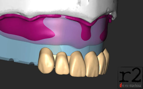 医用设计软件 - BiteReg  - Dentona AG - 导入 / 3D 打印 / 模型制作