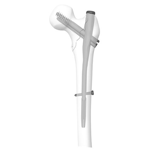 股骨髓内钉 - 305030 series - Boneunion Medical - 近端固定 / 直 / 左