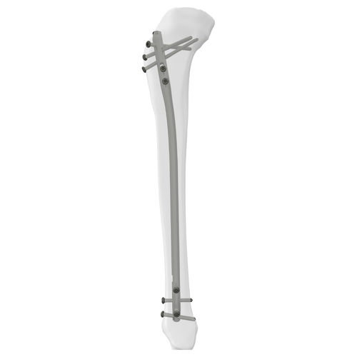 胫骨髓内钉 - 305014 series - Boneunion Medical - 近端固定 / 远端固定 / 直