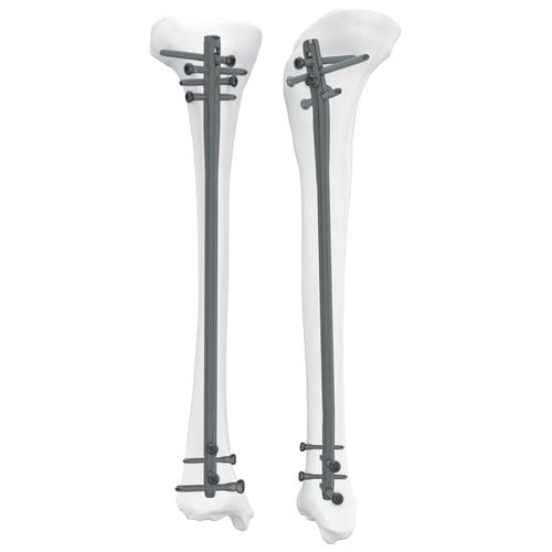胫骨髓内钉 - 305050 series - Boneunion Medical - 近端固定 / 远端固定 / 直