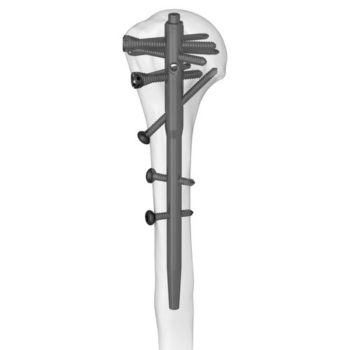 肱骨髓内钉 - 305077 series - Boneunion Medical - 近端固定 / 远端固定 / 直