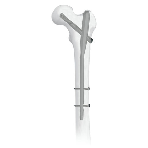 股骨髓内钉 - 30500 series - Boneunion Medical - 近端固定 / 钛