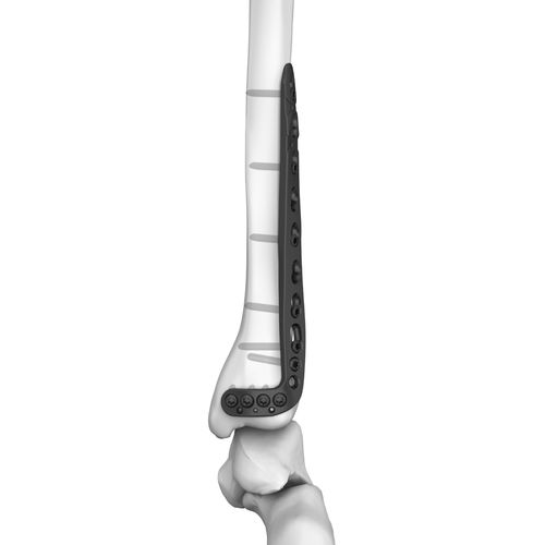 胫骨加压接骨板 - 301026 series - Boneunion Medical - 远侧 / 侧面 / 锁定