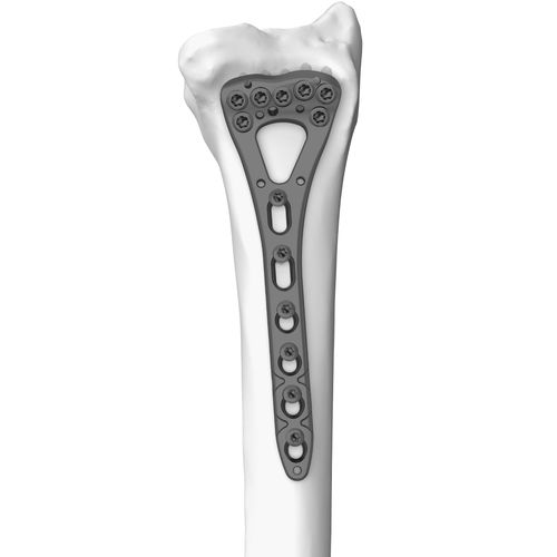桡骨加压接骨板 - 301077 series - Boneunion Medical - 远侧 / 锁定 / 钛