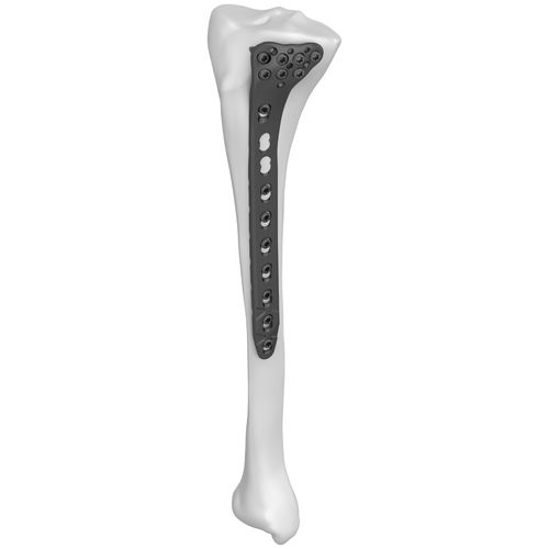 胫骨加压接骨板 - 301022 series - Boneunion Medical - 近端 / 侧面 / 锁定
