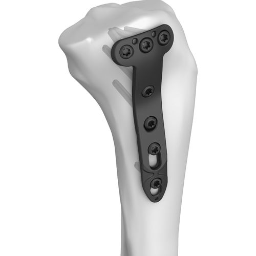 胫骨加压接骨板 - 301005 series - Boneunion Medical - 近端 / 中间 / 锁定