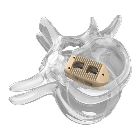 腰椎间融合器 - 4000 series - Aplus Biotechnology - 后入路 / PEEK材质