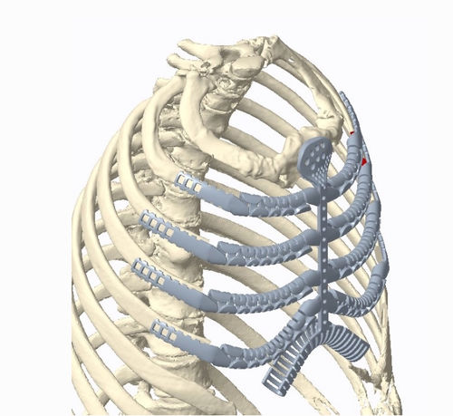 骨肉瘤切除重建人工肋骨 - Osteobionix