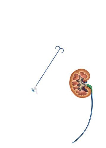 输尿管血管通路 - FY series - Hunan Endovascular Device Co., Ltd. - 肾脏 / 可定向 / 无损伤