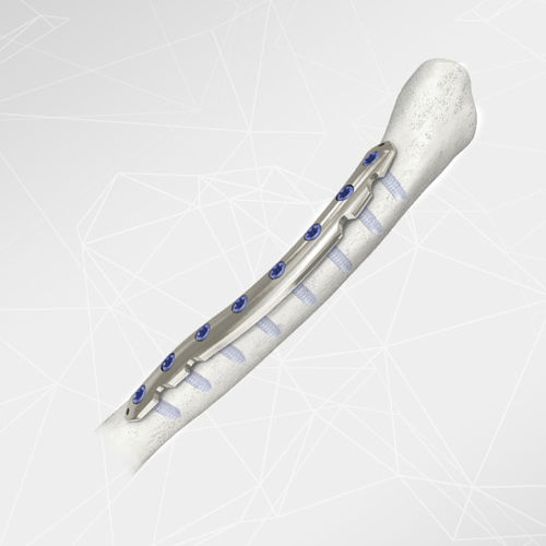 锁骨加压接骨板 - LOQTEQ® 2.7 - aap Implantate - 侧面 / 中间 / 锁定