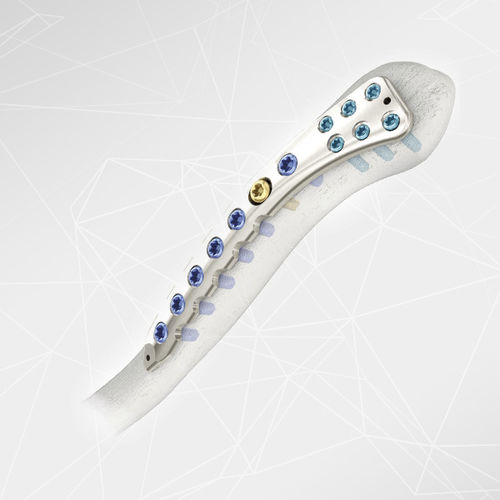 锁骨加压接骨板 - LOQTEQ® 2.7 - aap Implantate - 侧面 / 锁定 / 金属