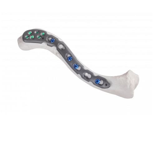 锁骨加压接骨板 - 10-54813 - AF Medical   - 前外侧 / 锁定 / 金属