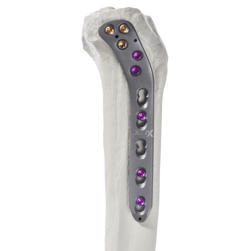 胫骨加压接骨板 - 10-62603 - AF Medical   - 近端 / 侧面 / 锁定