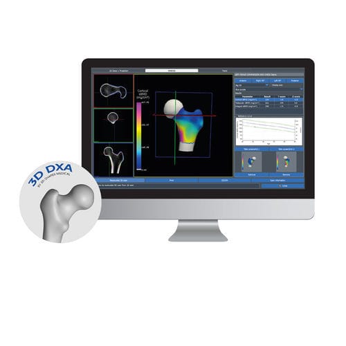 3D可视化软件 - 3D-DXA - DMS Imaging - 用于骨密度仪