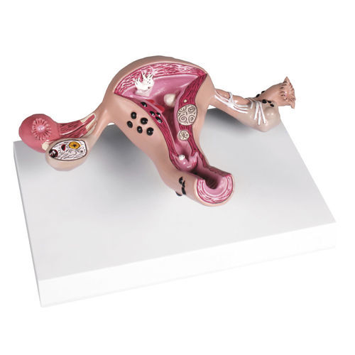 阴道解剖模型 - L262 - Erler-Zimmer - 子宫 / 子宫 / 卵巢