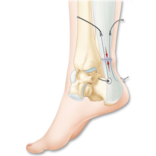 跟腱人工韧带 - Tenolig® - FH Orthopedics - 合成