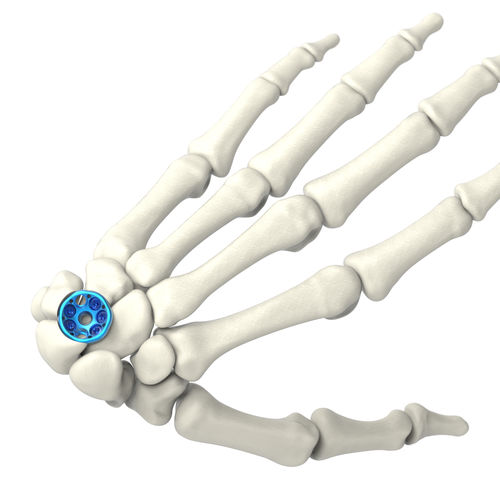 腕骨关节固定板 - ARIX 2.5 - Jeil Medical Corporation - 锁定 / 钛