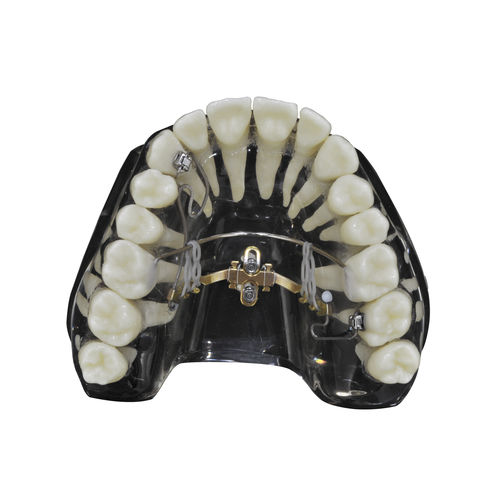 锥形牙齿植入物