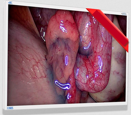 医用监视器 - EndoVue Plus - NDS Surgical Imaging - 内窥镜 / 高解析度 / 55"