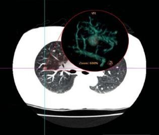 分析软件 - NeuLungCARE - Neusoft Medical Systems  - 可视化 / 测量 / CAD
