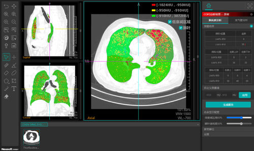医疗可视化软件 - NeuLungCARE - Neusoft Medical Systems  - 分析 / CAD / 测量