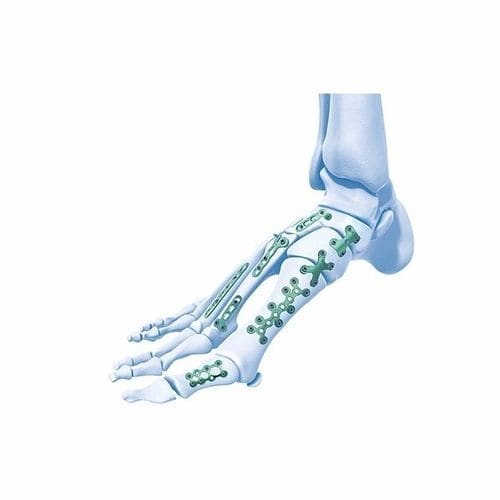 跖骨加压接骨板 - Double Medical Technology - 脚指骨 / 跗骨 / 锁定