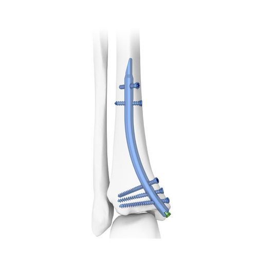 胫骨髓内钉 - DTN - Double Medical Technology - 远端固定