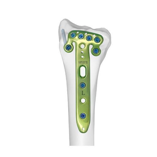 桡骨加压接骨板 - Double Medical Technology - 远侧 / 锁定