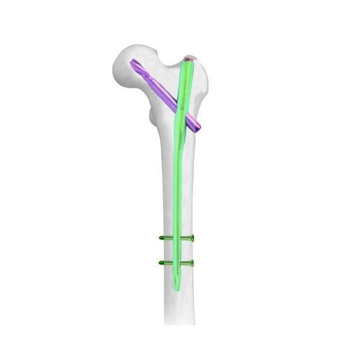 股骨转子髓内钉 - PFNA - Double Medical Technology - 股骨 / 近端固定 / 远端固定