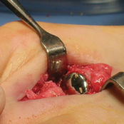 足指间关节植入物 - HemiCAP DF®  - Arthrosurface