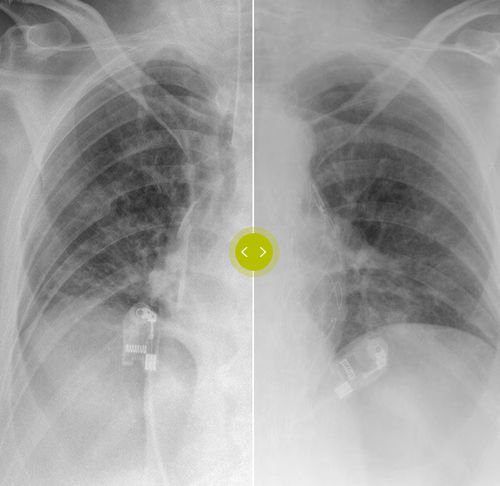 采集算法 - SkyFlow Plus - Philips Healthcare/飞利浦 - 模拟 / 机器学习 / 放射学
